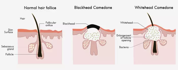Difference between whiteheads and blackheads