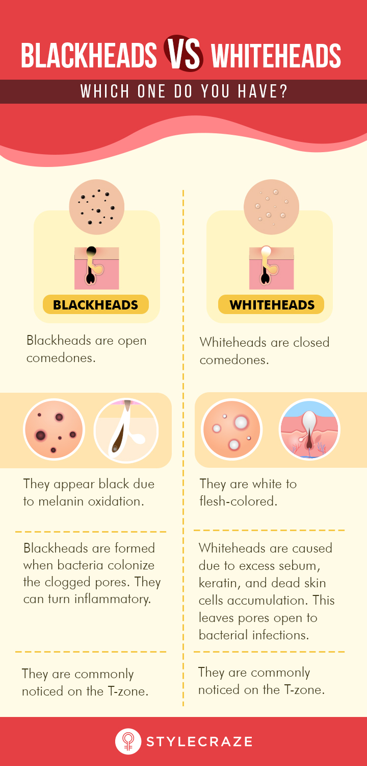 Whiteheads vs blackheads