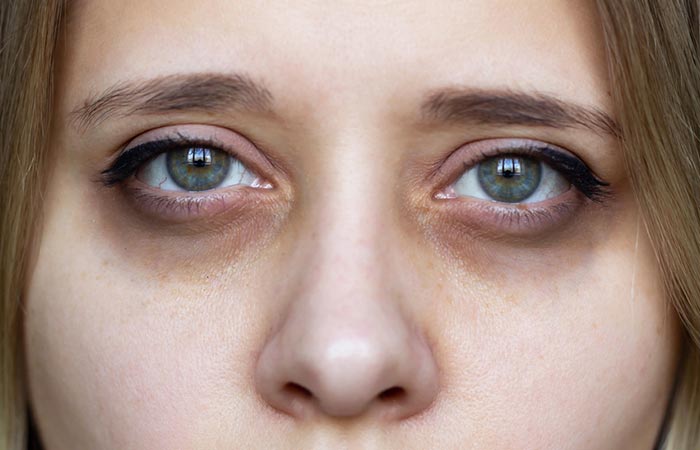 This woman with dark circles and sunken eyes can get under-eye fillers