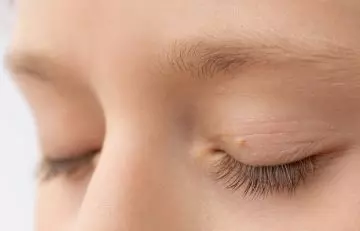 Woman with skin tag on eyelid