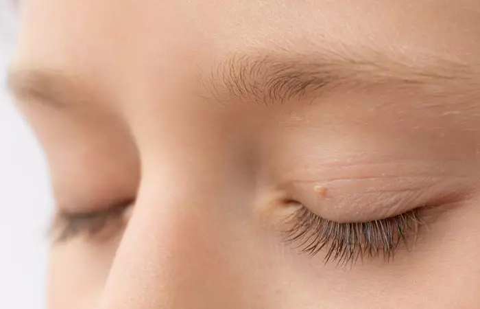 Woman with skin tag on eyelid