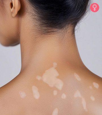 The sudden occurrence of pale patches on the skin often has valid reasons and thankfully, treatments.