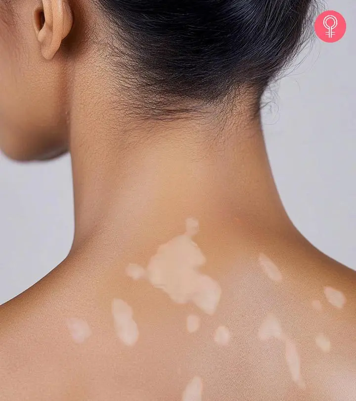 Woman With White Spots On Skin