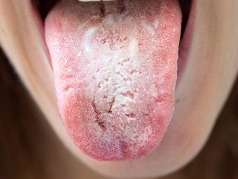 Home Remedies for Oral Thrush in Hindi