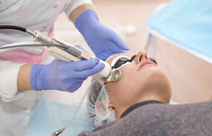 Woman getting laser resurfacing done for pitted acne scars