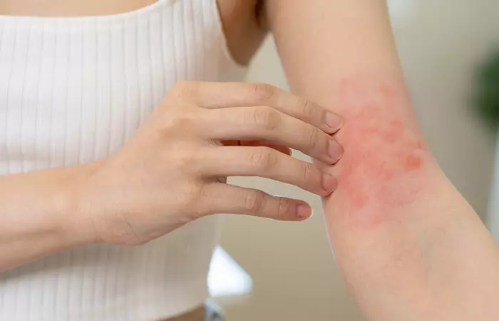 Sarsaparilla may help manage psoriasis