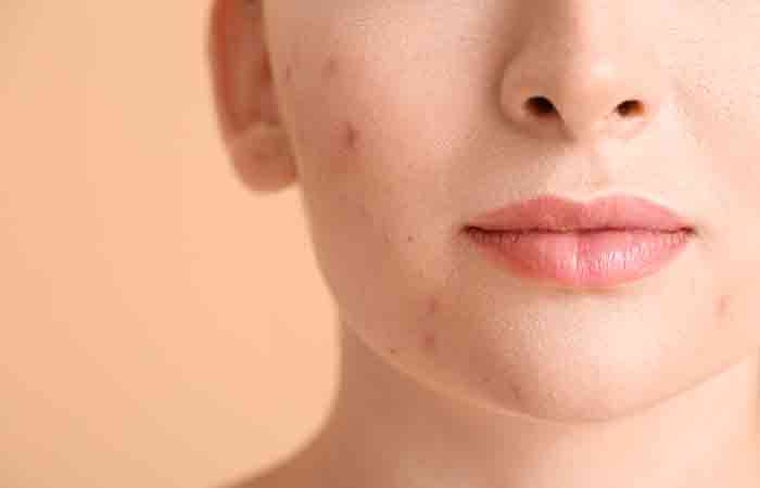 Apricot oil may help prevent acne