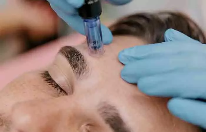 Woman getting microneedling with radiofrequency done for pitted acne scars