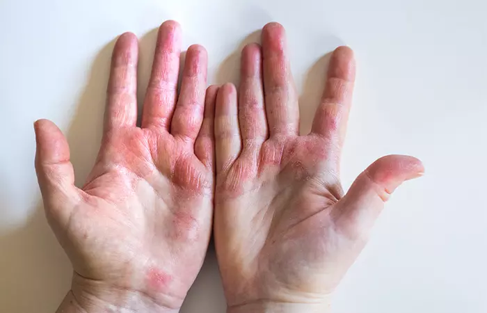 Reddened irritated palms , a symptom of jalapeno hands