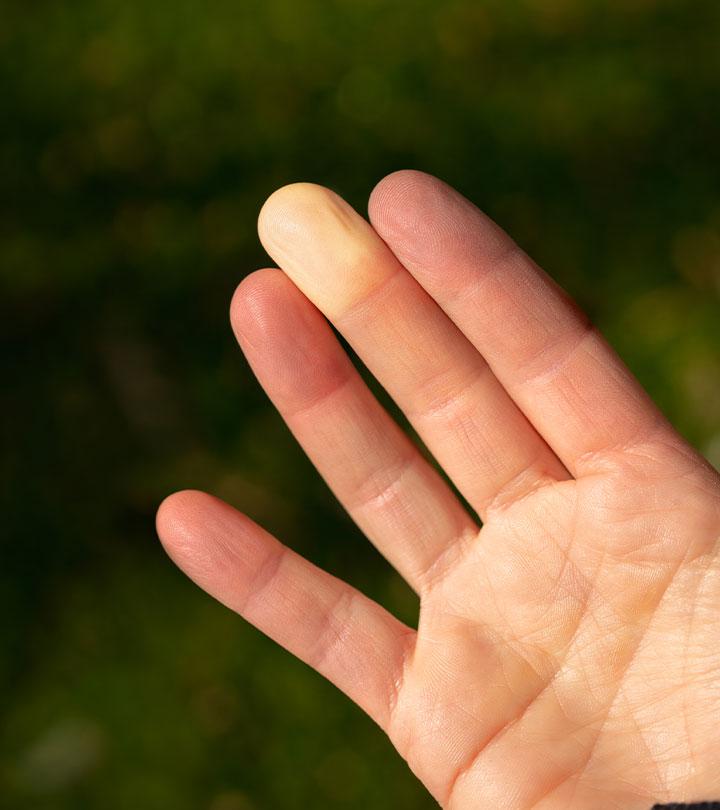 त्वग्काठिन्य (स्क्लेरोडर्मा) के कारण, लक्षण और इलाज – Scleroderma in Hindi