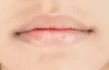 The common symptoms of lip dermatitis