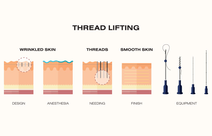 Thread lift procedure