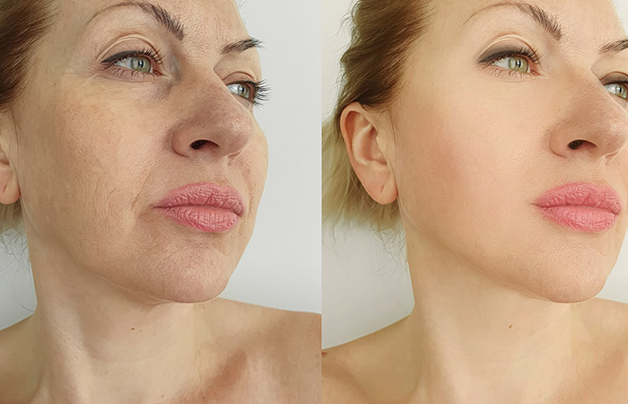 Thread lift before and after image 2