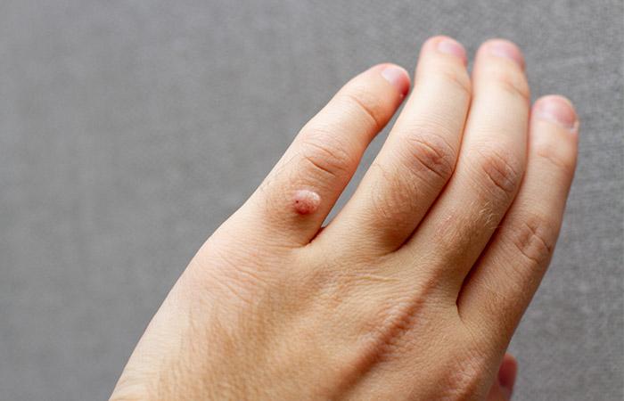 A wart on the finger