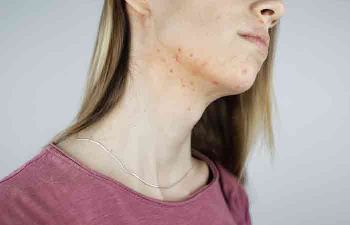 Acne and chickenpox cause pitted scars