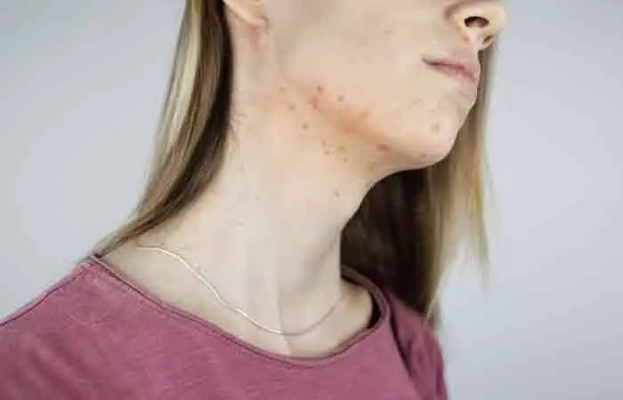 Acne and chickenpox cause pitted scars