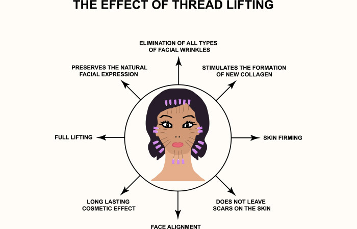 Effects of thread lift