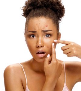 9 Best Essential Oils To Treat Acne