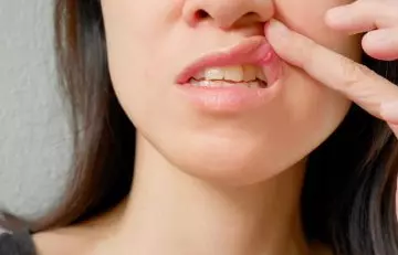 Canker sores are a type of white spots that occur inside and on the lips
