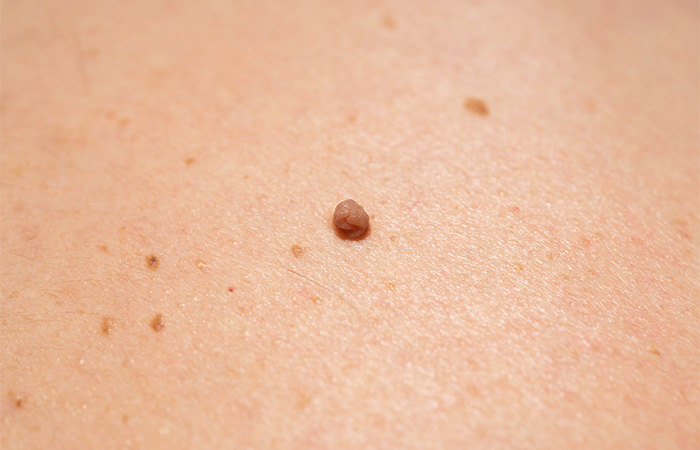 Close up of a genital skin tag