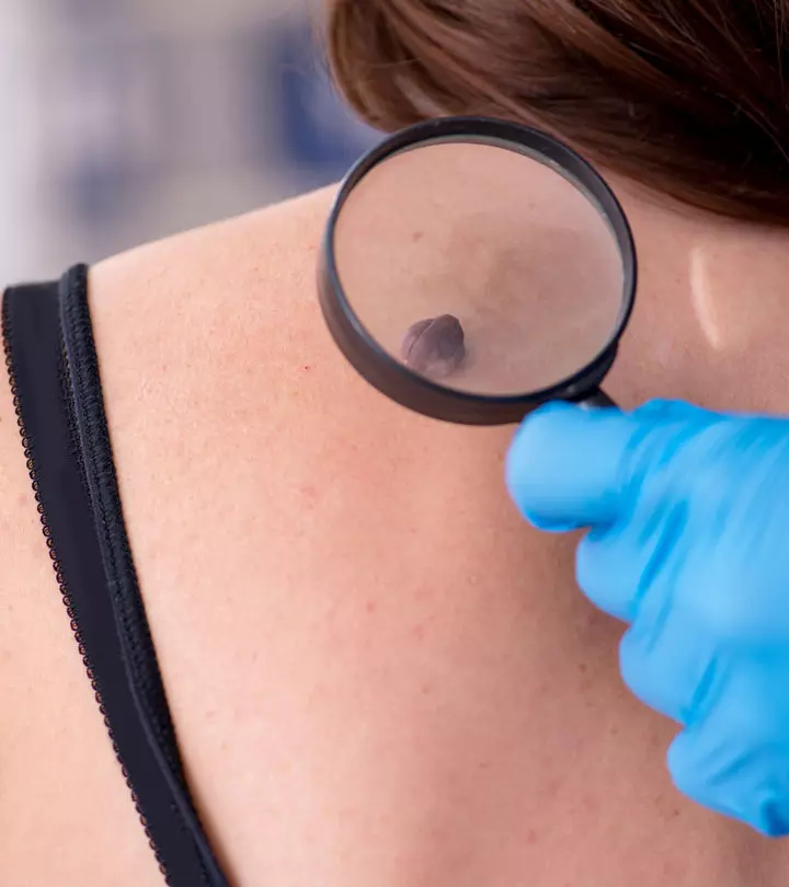 A Women With Cutaneous Horn On Back