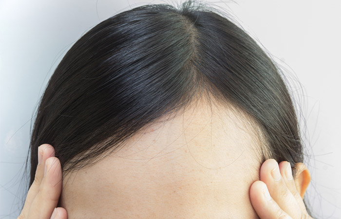 Closeup of woman's high hairline