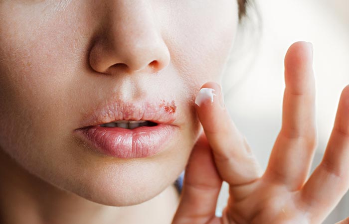 Woman with herpes cold sore and dry skin
