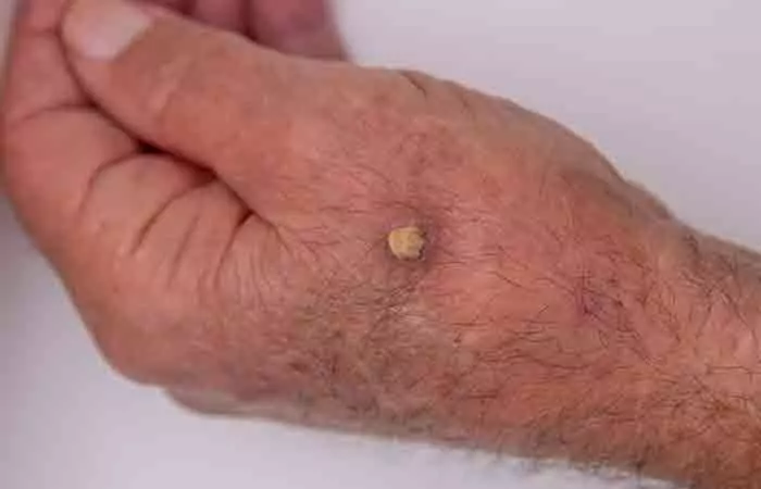 The cutaneous horn on hand