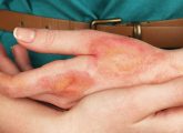 Ice Burn: Causes, Symptoms, And Treatment