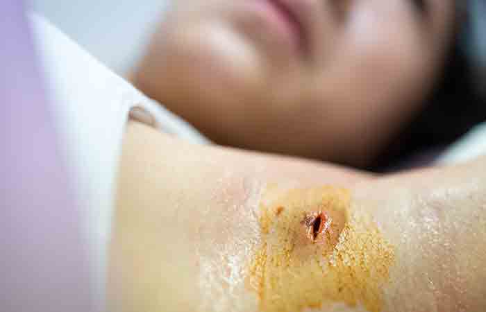 Woman undergoing skin abscess surgery