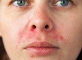 How To Get Rid Of Perioral Dermatitis And Prevention Tips
