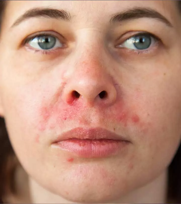 Woman Suffering From Perioral Dermatitis