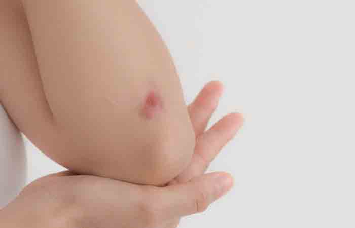 Wound on elbow may heal with Kukui nut oil