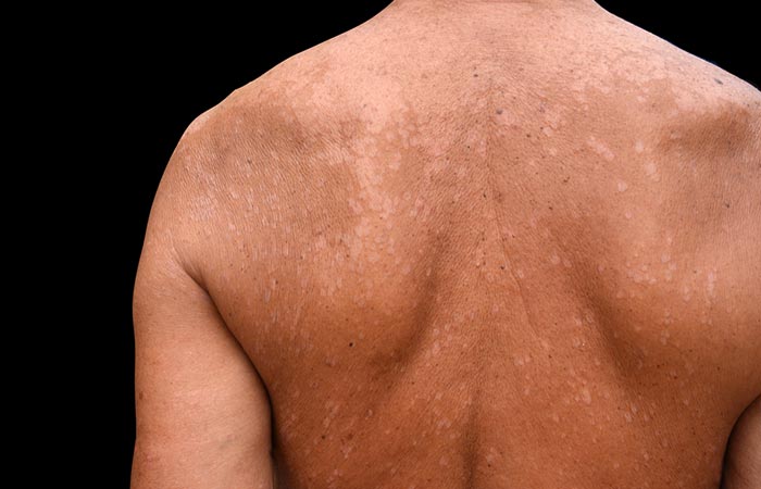 Pityriasis versicolor on a man’s back