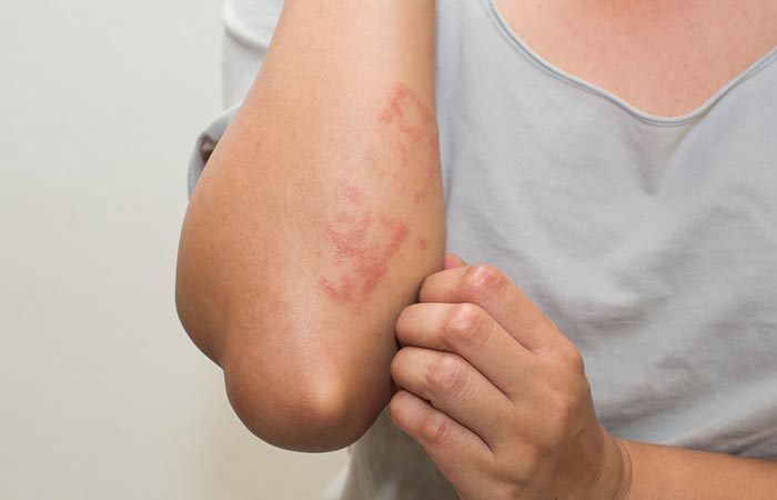 Woman itching a rash on her arm