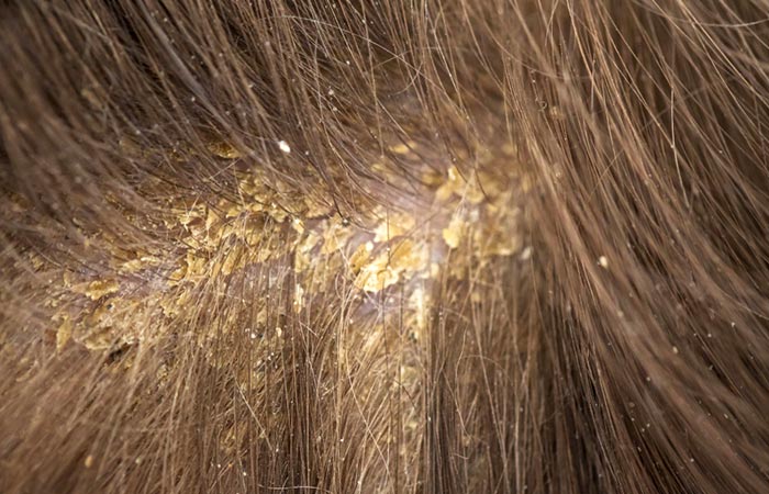 Seborrheic dermatitis on a scalp