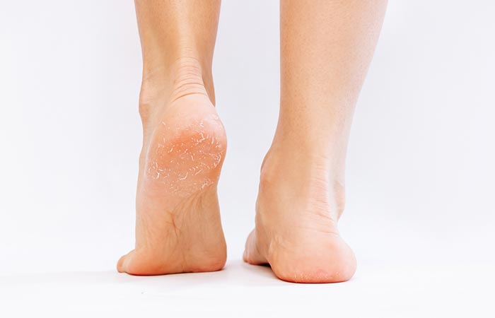 Thickened skin at the heel of a foot