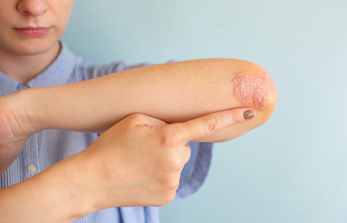 Woman with psoriosis may experience dry skin