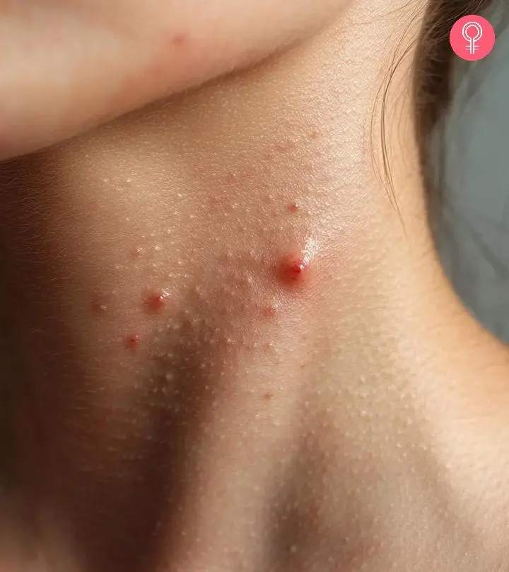 Person With Pimples On Their Neck