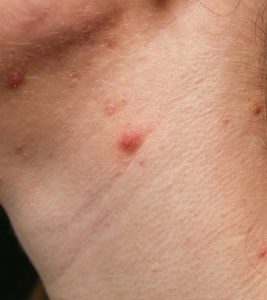Pimples On Neck: Causes, Treatments, And Prevention