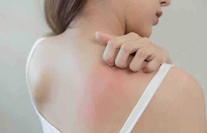 Woman with itchy back due to Kukui nut oil