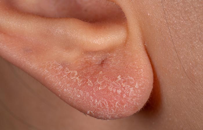 Close up of dry skin in ear area