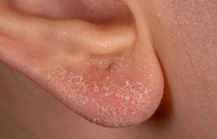 Dry Skin In Ears 9 Effective Home Remedies And Prevention Tips