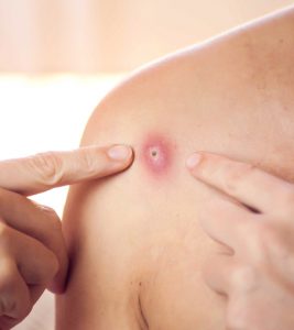 Skin Abscess All You Need To Know