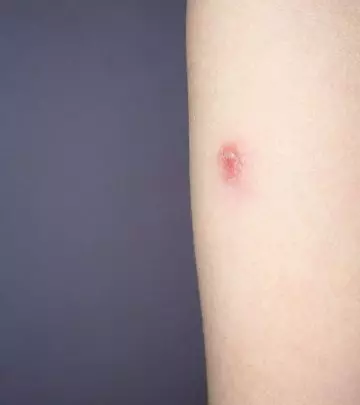 Close up of slowly healing skin abscess on arm