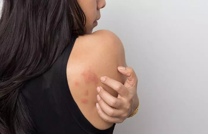 Woman scratching rash on her back