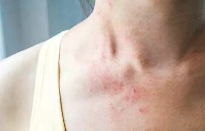 Woman with rashes on her arm