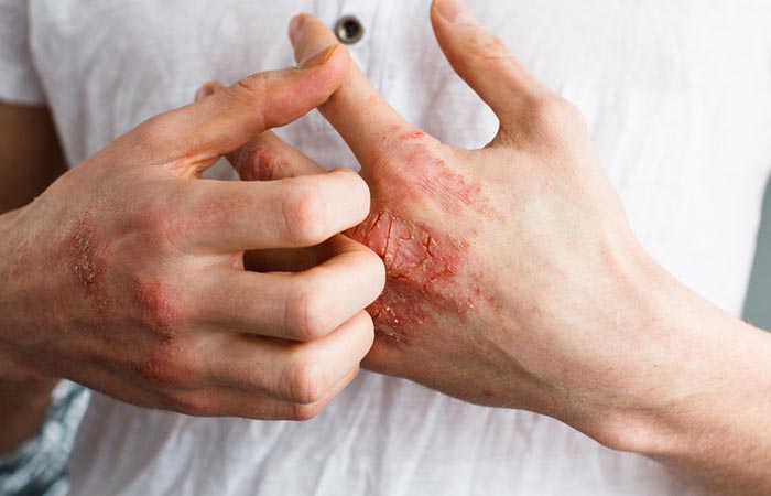 Woman with dry skin rash on her hands