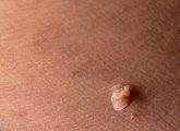 Genital Skin Tags: Symptoms, Causes, Treatment, & Prevention