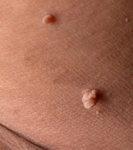 What Are Genital Skin Tags And How To Get Rid Of Them